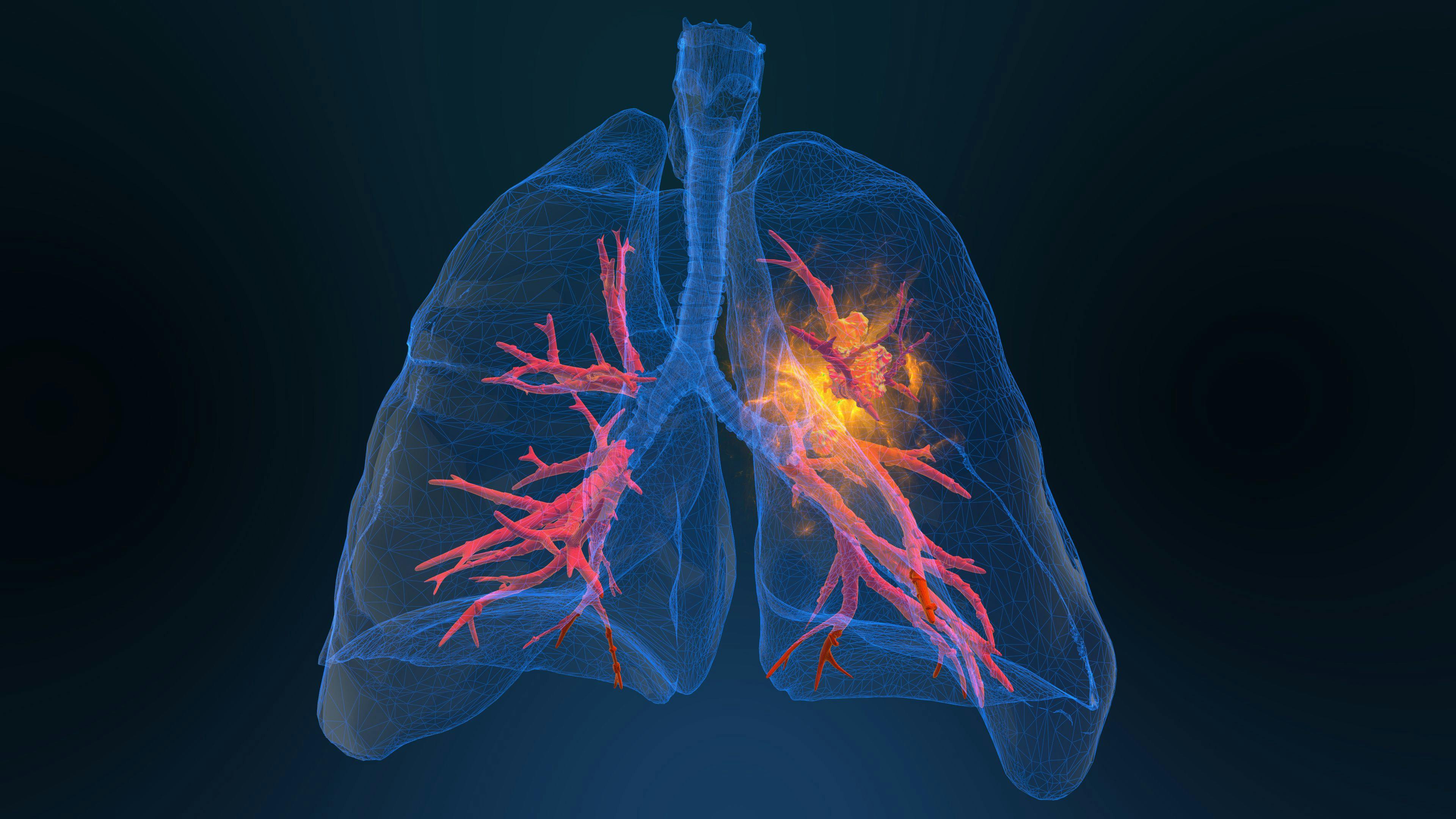 Phase III Trial for Keytruda Combination in Lung Cancer Stopped for Lack of Survival Benefit