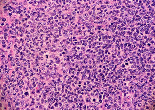 Image credit: Lisa | stock.adobe.com. High grade follicular lymphoma with marginal zone differentiation. Multiple lymphocytes are undergoing mitosis. Microscopic view.