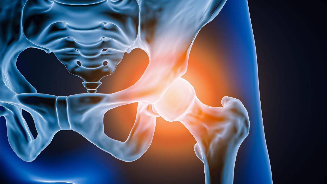 Anterior or front view of human hip joint and bones with inflammation or injury 3D rendering illustration. Pathology, articular pain, anatomy, osteology, rheumatism, medical and healthcare concept. Image Credit: Adobe Stock Images/Matthieu