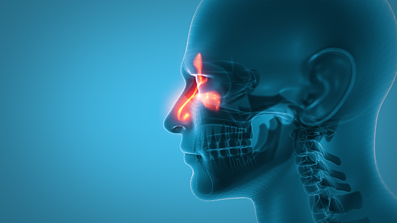 3d illustration of human head whith sinusitis. Image Credit: Adobe Stock Images/labden