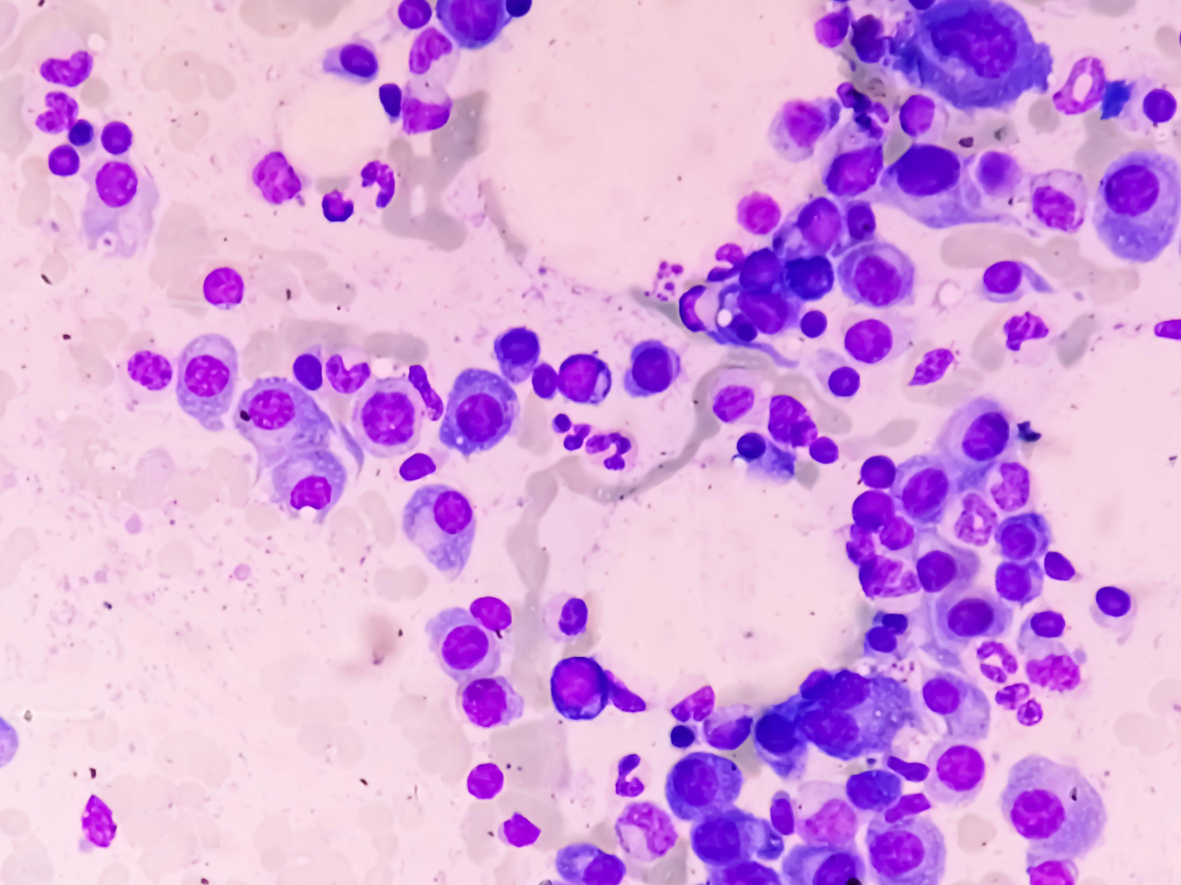 Image credit: Saiful52 | stock.adobe.com. Microscopic view of bone marrow slide feature are suggestive Multiple myeloma, also known as myeloma, is a type of bone marrow cancer.