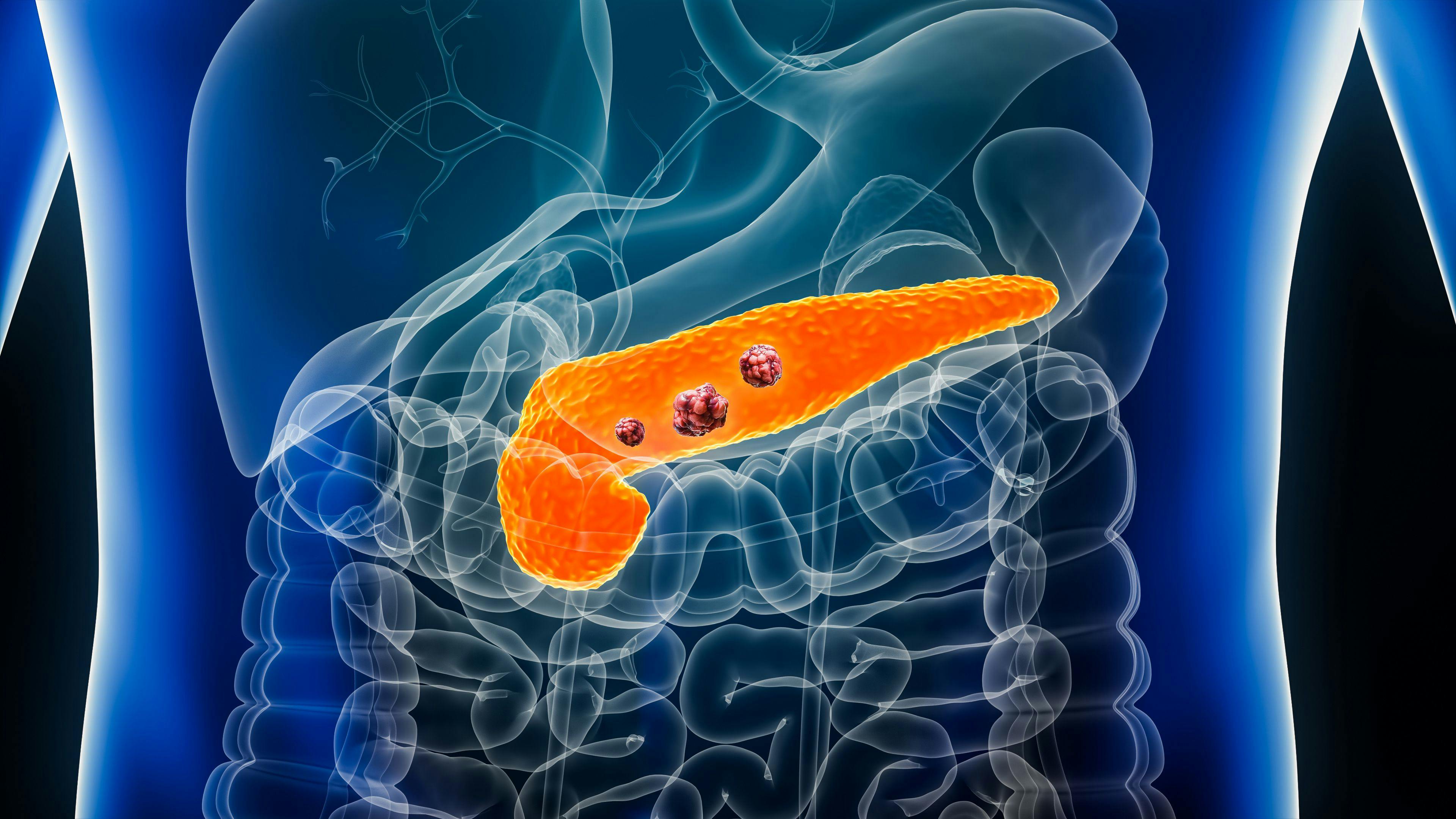 Image credit: Matthieu | stock.adobe.com. Pancreas or pancreatic cancer with organs and tumors or cancerous cells 3D rendering illustration with male body. Anatomy, oncology, disease, medical, biology, science, healthcare concepts