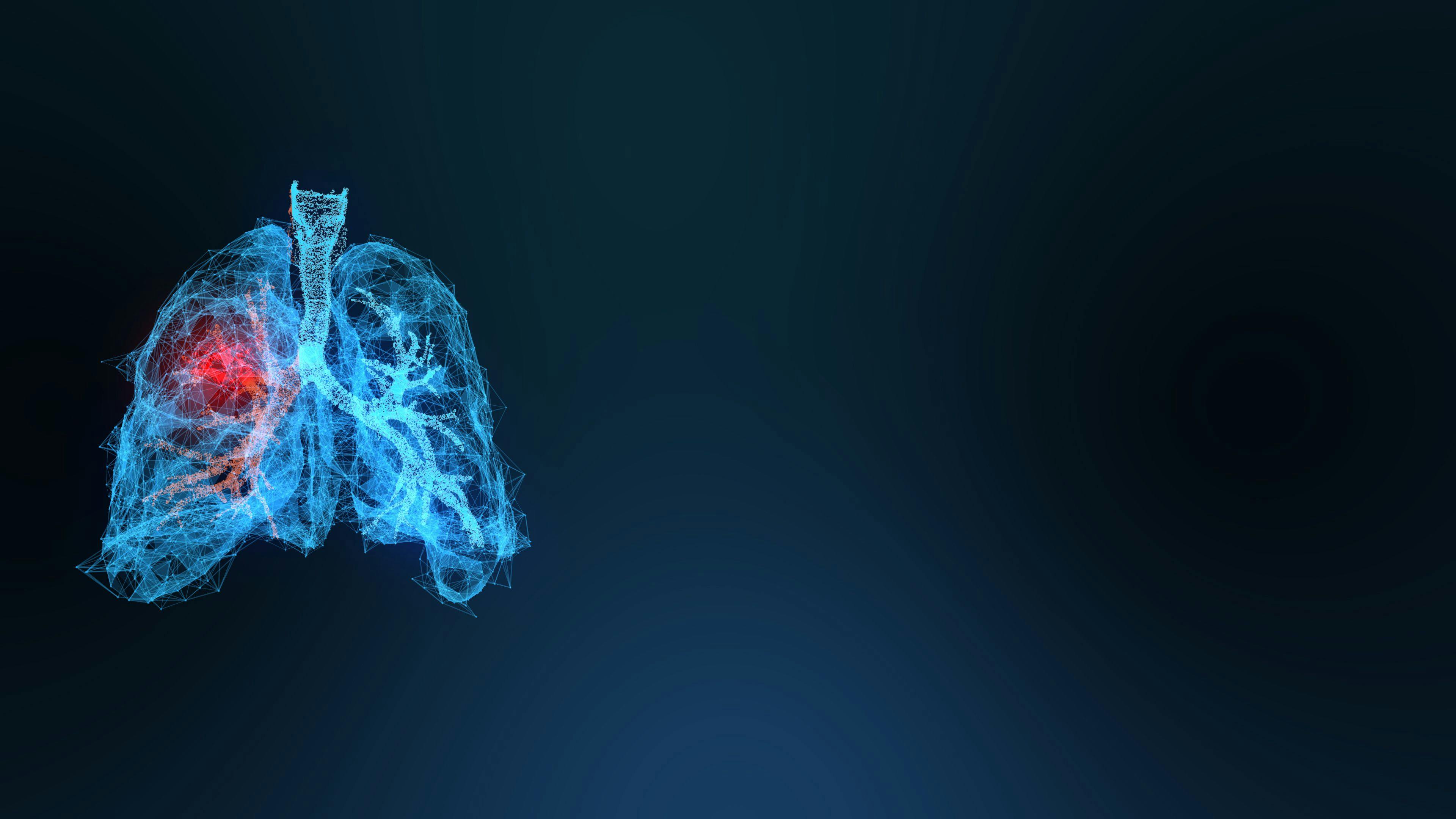 Image credit: appledesign | stock.adobe.com. 3d rendered illustration of lung cancer 3D illustration