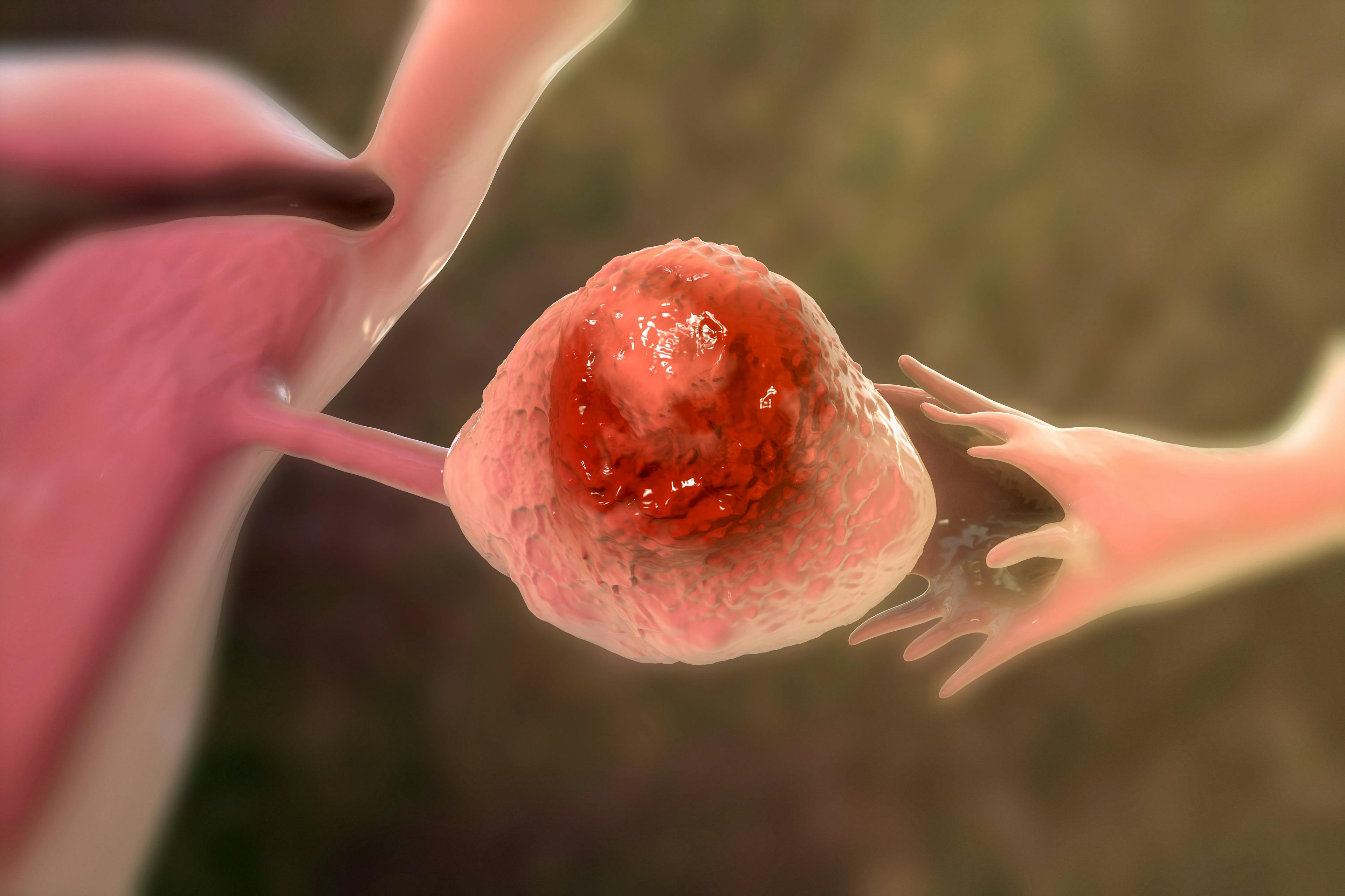 Novel ADC in Trials for Ovarian, Fallopian Tube, Primary Peritoneal Cancers Gets FDA Fast Track Designation