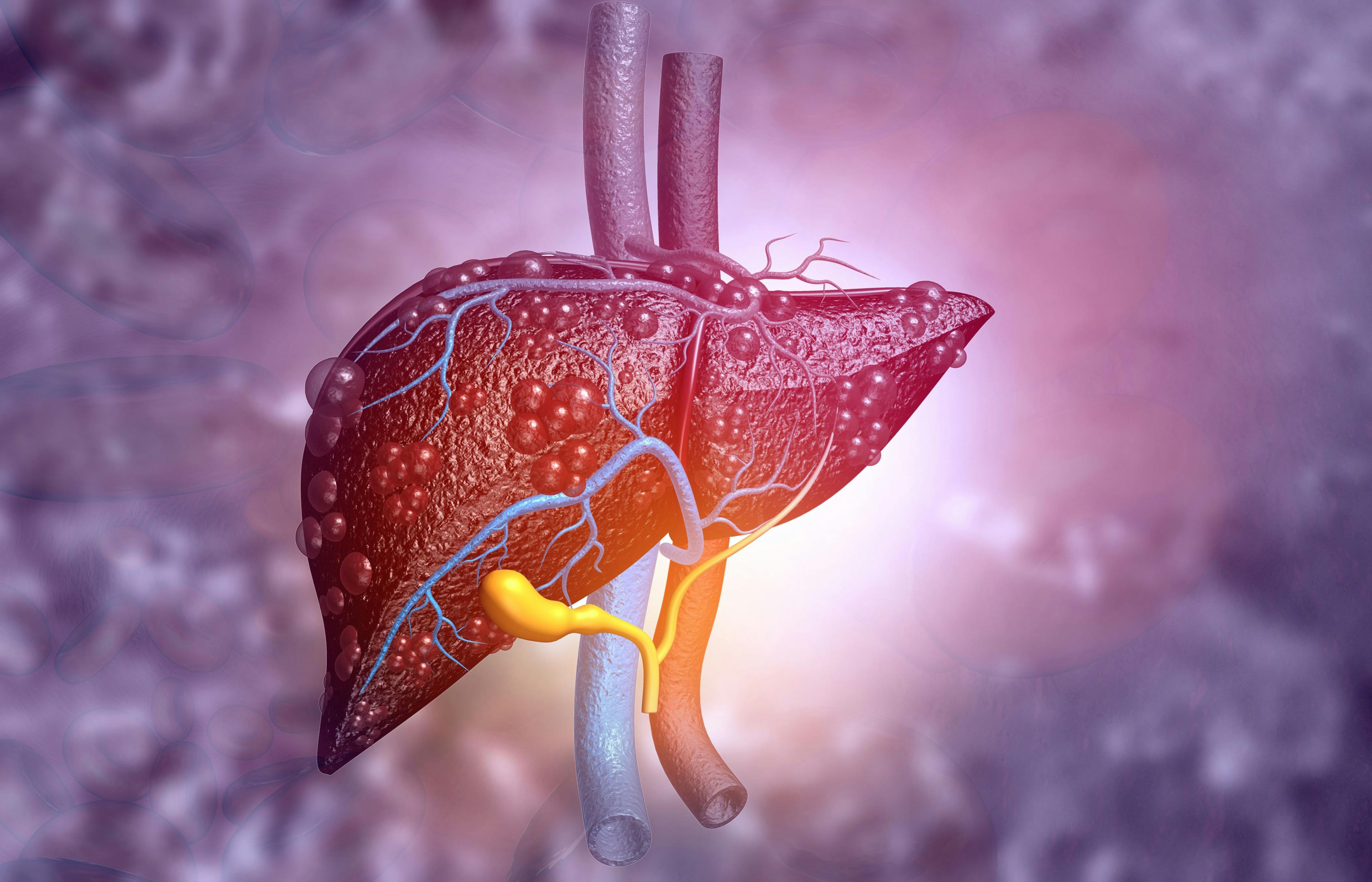 GLP-1 Agonists Could Be Key in Reducing Severe Liver Disease for Type 2 Diabetes Patients