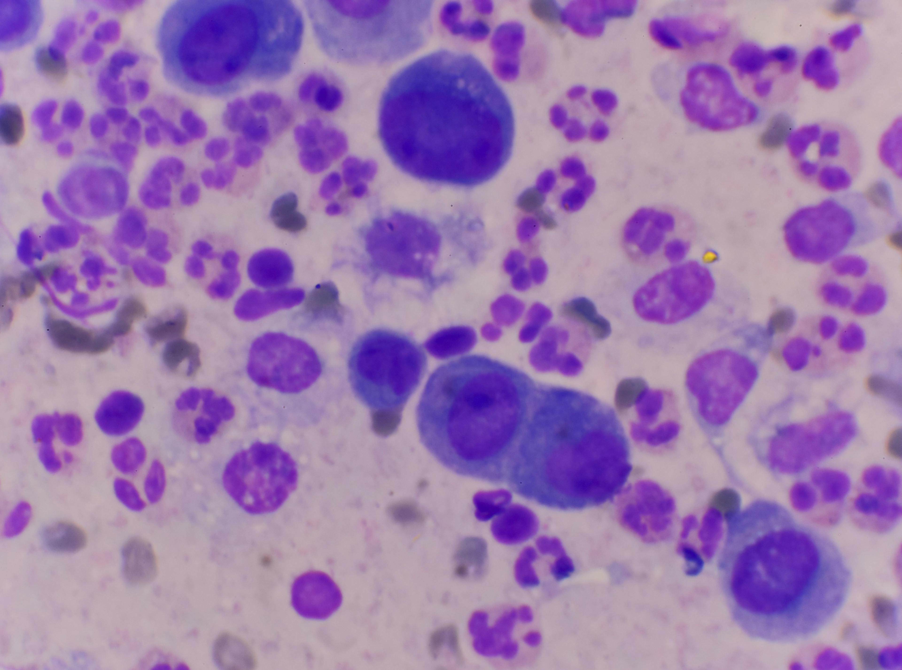 Mesothelial cells in body fluid sample. Image credit: toeytoey | stock.adobe.com